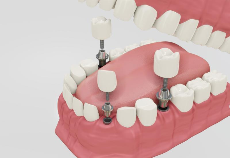 Benefícios da reabilitação oral com implantes dentários: além da estética, uma melhoria na saúde bucal