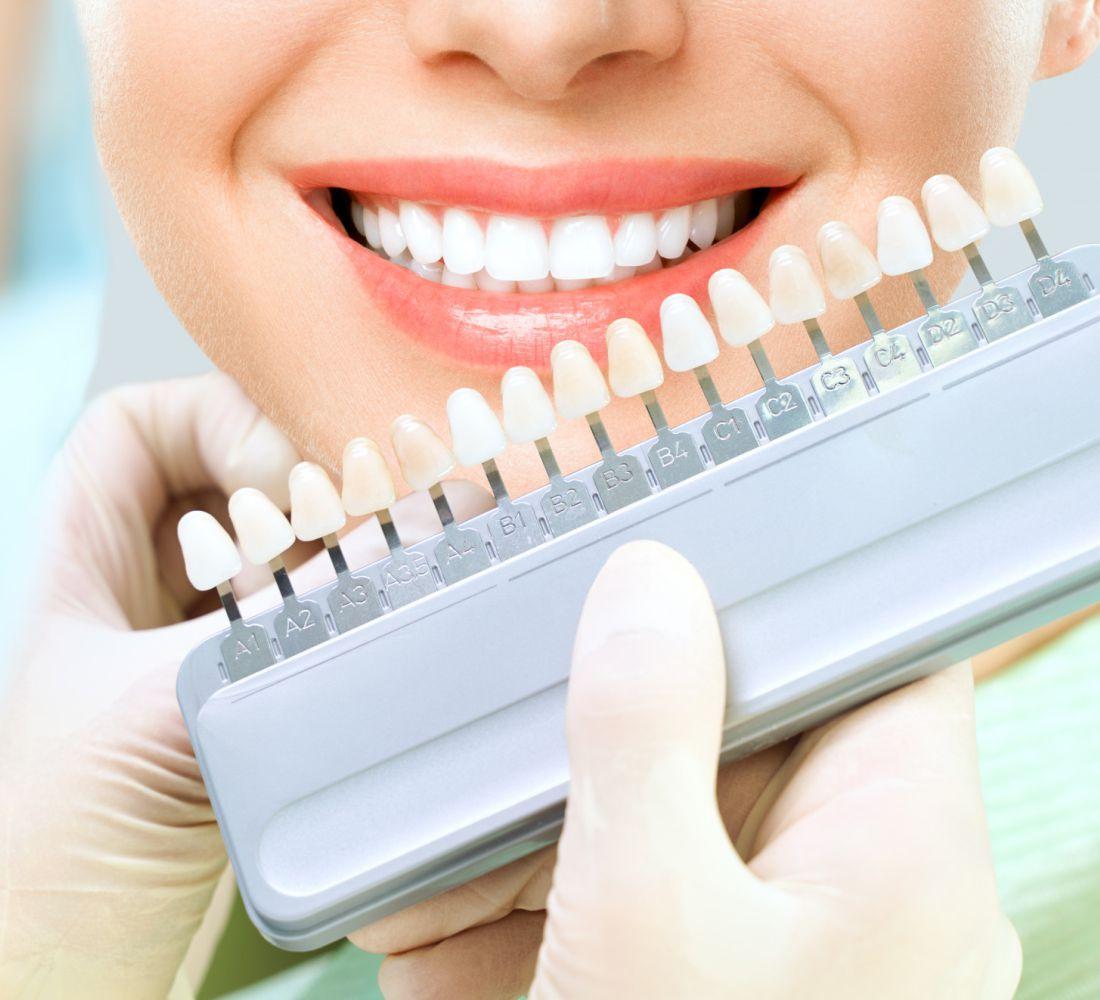 Facetas de Resina ou Porcelana - Dentística - Tratamento Odontológico - Copacabana Odonto