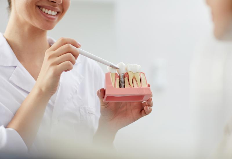 Implantes dentários: Recupere seu sorriso e qualidade de vida com a reabilitação oral