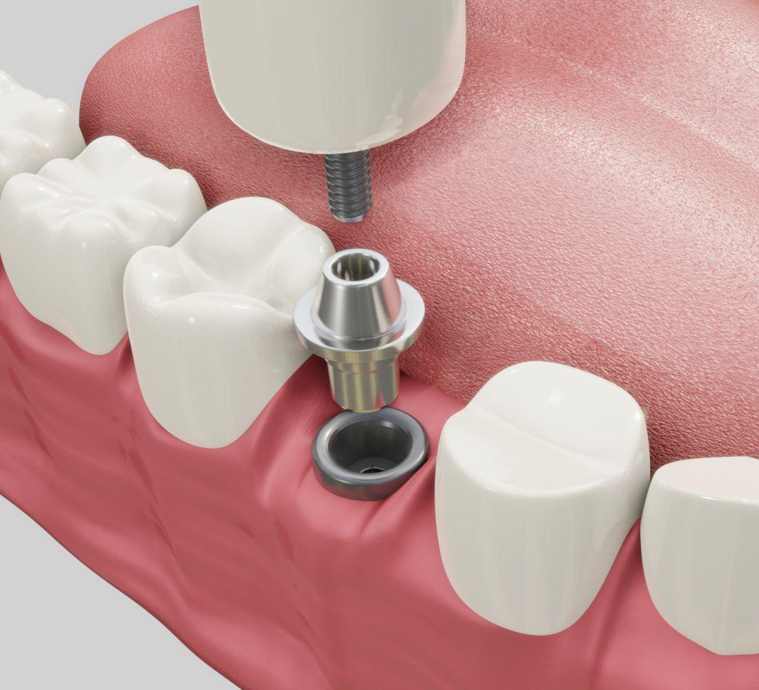 Implantodontia - Tratamento Odontológico - Copacabana Odonto