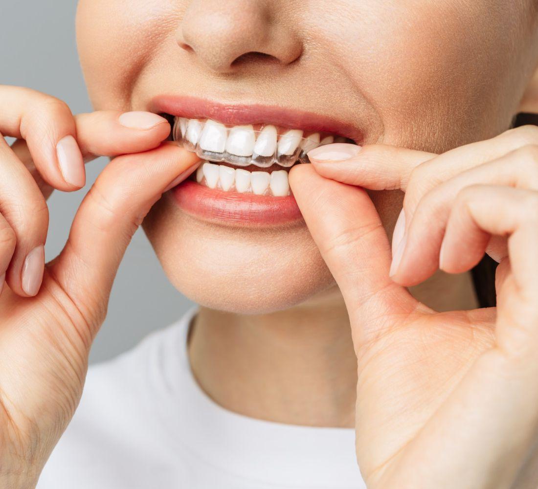 Ortodontia - Tratamento com Alinhadores Invisíveis Odontológico - Copacabana Odonto